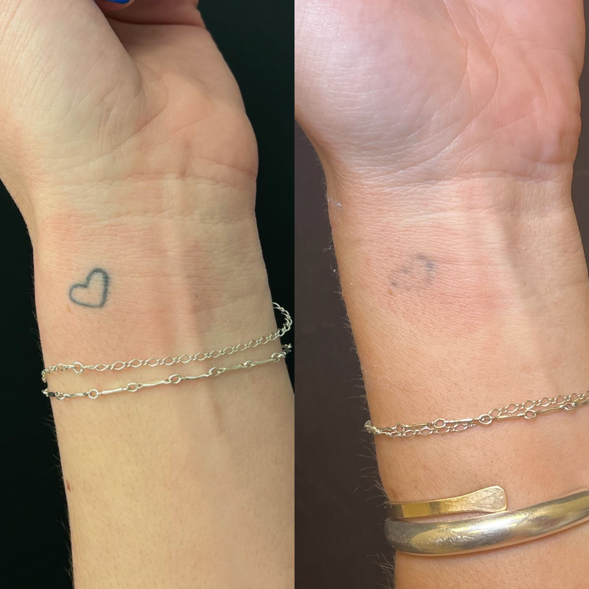 Side-by-side comparison showing a wrist heart tattoo fading